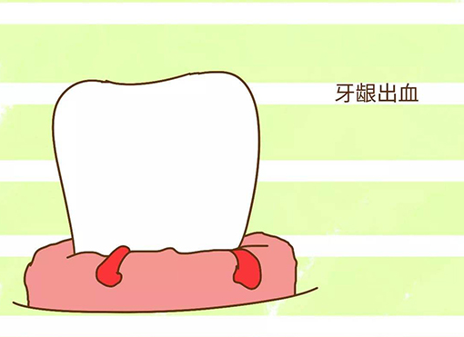 牙龈出血是怎么回事，牙龈出血你还觉得是小问题吗