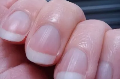 指甲有竖纹是身体的什么信号(指甲有竖纹是身体的什么信号中医)
