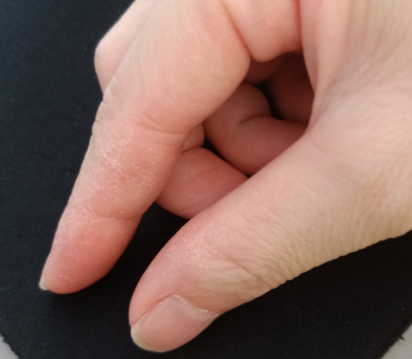 手脱皮是什么原因导致的，小小手脱皮也有大问题藏着