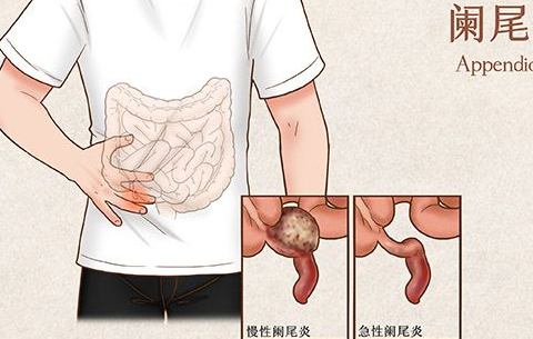阑尾炎是哪个部位疼 快看看你这个部位会发生疼痛吗