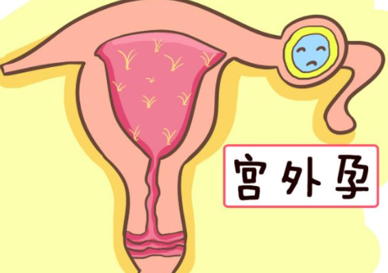 宫外孕的症状有哪些表现(宫外孕早期症状有哪些)
