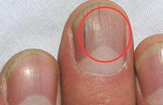 指甲有竖纹是身体的什么信号(指甲有竖纹是身体的什么信号了)