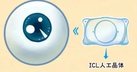ICL人工晶体植入价格-ICL人工晶体植入价格看近的视