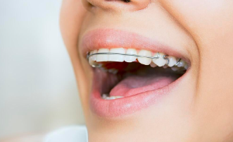 矫正牙齿的费用是多少 矫正牙齿的最佳年龄