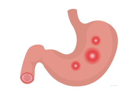 胃溃疡症状表现有哪些（胃溃疡分为典型症状和伴随症状）