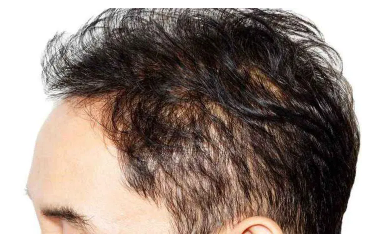 头发稀疏怎么恢复 这三种办法帮你恢复头发