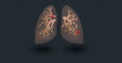 清理肺部结节方法