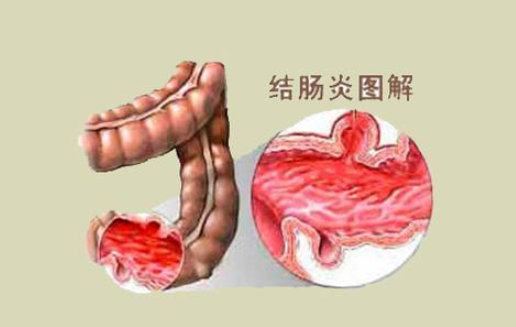 结肠炎的症状有哪些症状，患了结肠炎会出现哪些症状